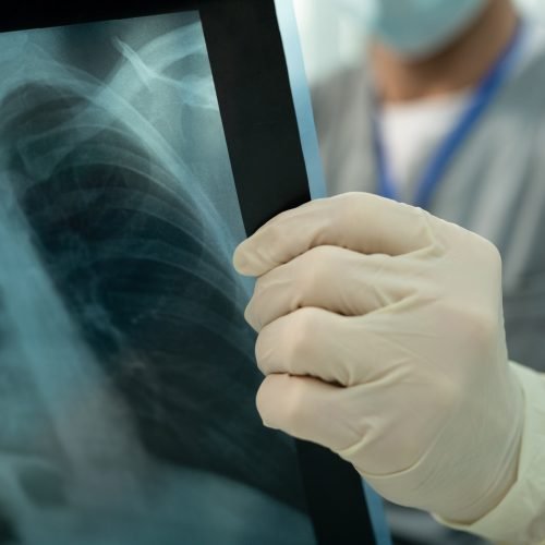 Doctor analyzing lung x-ray image